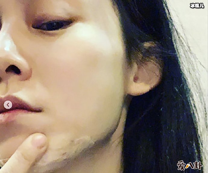 【WPT扑克】范玮琪发生了什么下巴缝15针？为何其那么遭网友嫌弃？